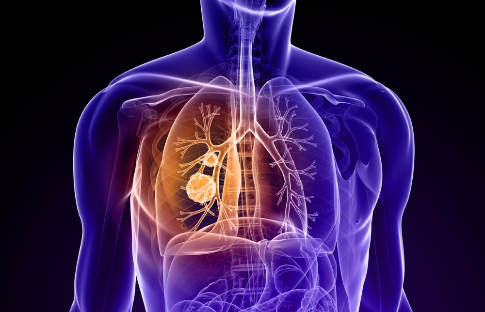 Do You Know the Warning Signs of Lung Cancer? June 2021